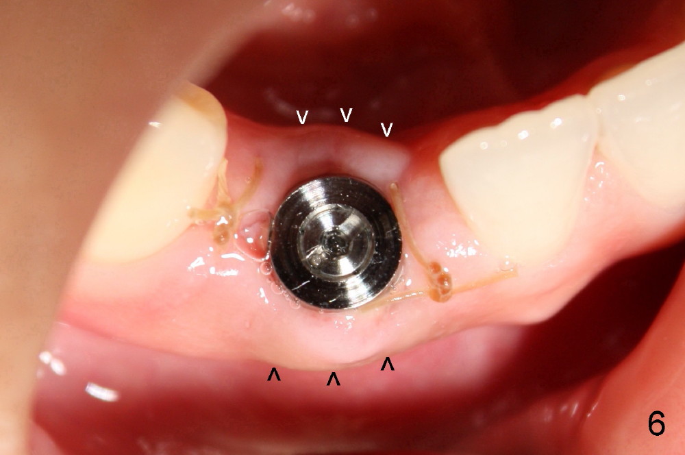 Immediate Implants for congenital missing teeth bone expansion and